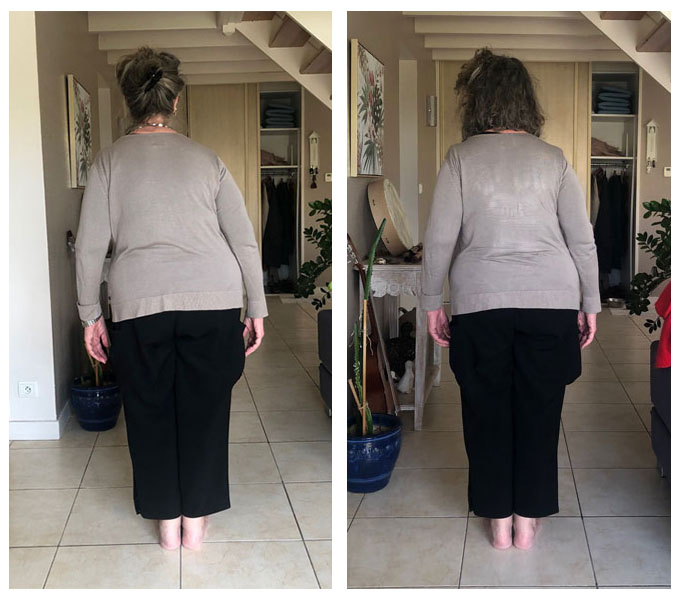 michelle back before after