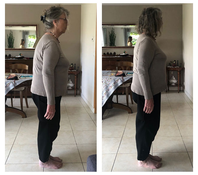 michelle side 1 before after